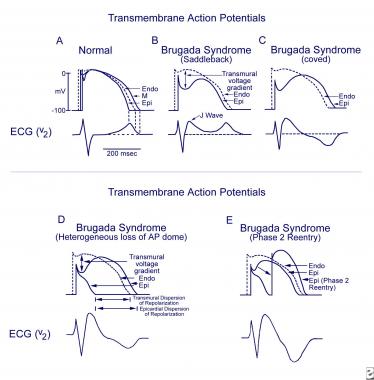brugada syndrome